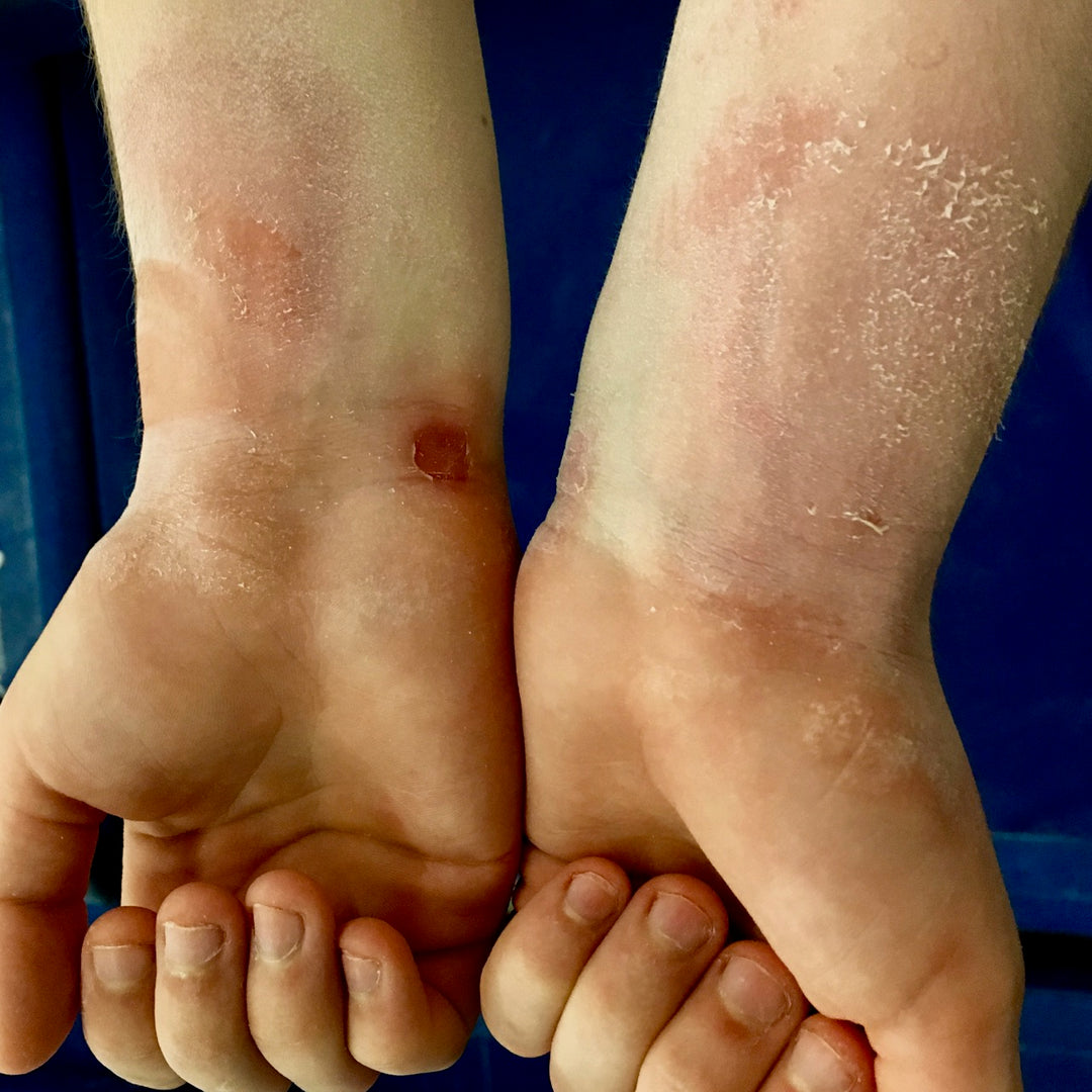 Gymnast's raw and blistered wrists